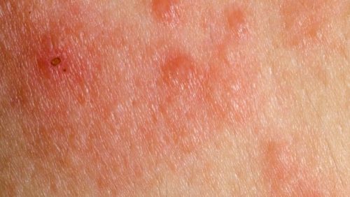 Συμπτώματα καρκίνου του δέρματος - Κοκκινίλες στο δέρμα