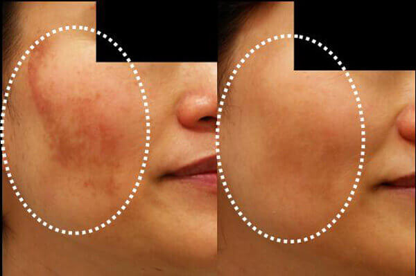 Μειώστε τον αποχρωματισμό του δέρματος με 5 μάσκες