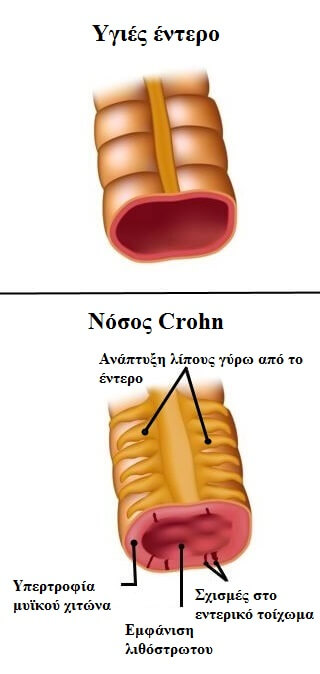 έντερο με νόσος του Crohn