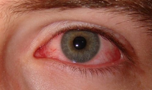 Πώς να καταπολεμήσετε την ξηροφθαλμία - Κόκκινο μάτι