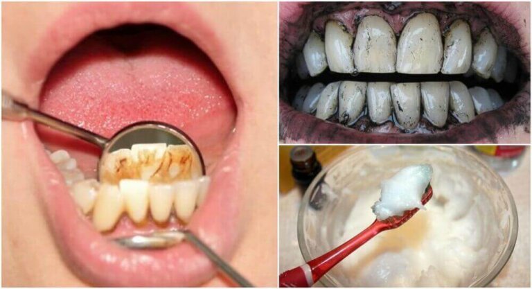 Αφαίρεση της πέτρας από τα δόντια σας με φυσικές θεραπείες