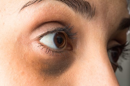 μάτια με μαύρους κύκλους σημαδια ορμονικής αστάθειας