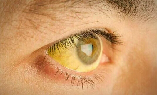 Σημάδια φλεγμονής στο συκώτι - Κιτρινισμένο μάτι