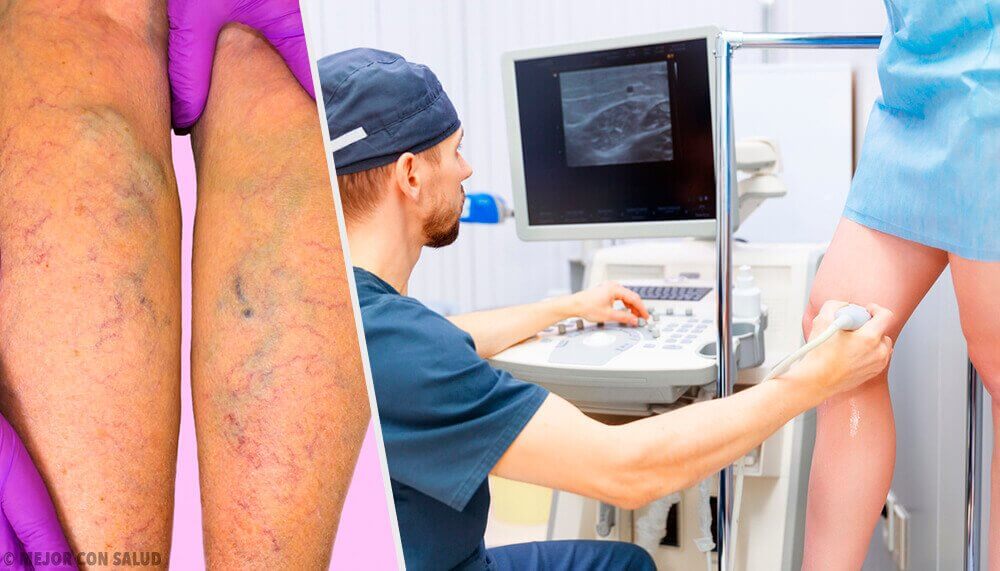 από στόματος θεραπείες για τους κιρσους