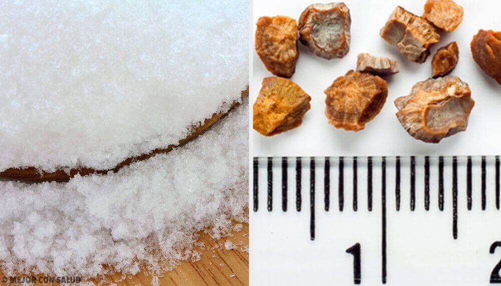 Απαλλαγείτε από τις πέτρες στα νεφρά