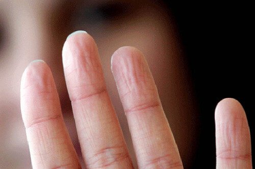9 προβλήματα υγείας που φανερώνουν τα χέρια μας