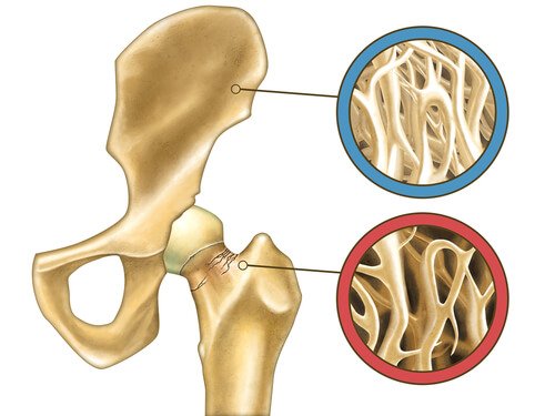 οστεοπόρωση σε οστά, τι πρέπει να γνωρίζετε για την οστεοπόρωση