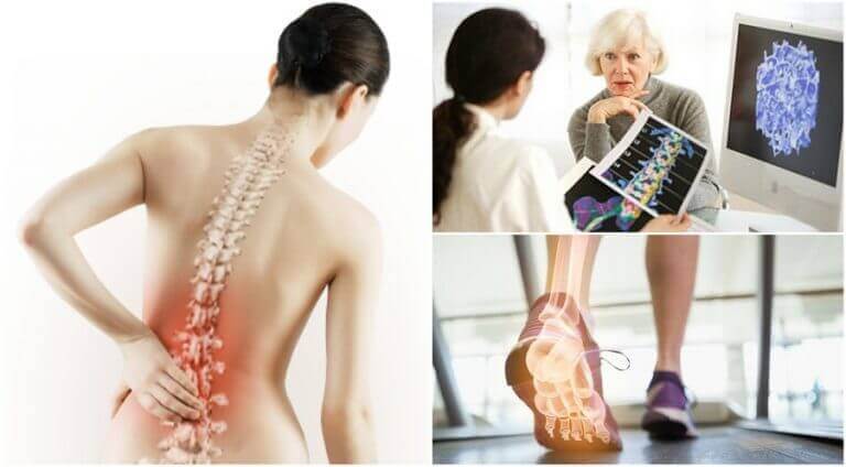 Πόνος στην πλάτη - οστεοπόρωση