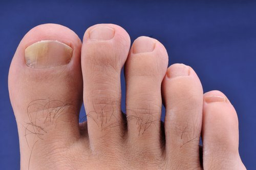 Δάκτυλα ποδιού με μυκητίαση- προβλήματα που προκαλούνται στα πόδια από τις σαγιονάρες
