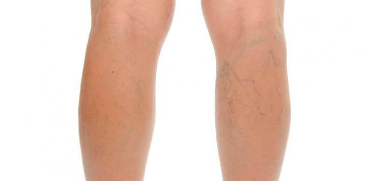 πόδια με κυταρρίτιδα - την αντιμετώπιση της κυτταρίτιδας