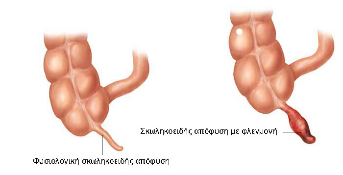 συμπτώματα σκωληκοειδίτιδας