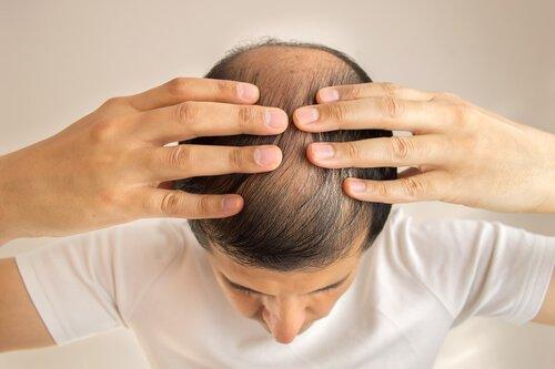 Μύθοι για την απώλεια μαλλιών - Άνδρας με φαλάκρα
