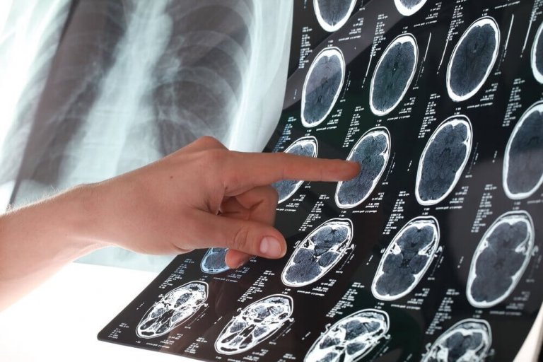 6 Συμβουλές για να αποφύγετε το εγκεφαλικό