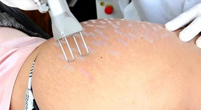 καταπολέμηση των ραγάδων, λέιζερ