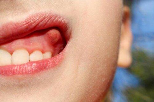 Πώς να θεραπεύσετε το απόστημα στα δόντια με 10 σπιτικές θεραπείες