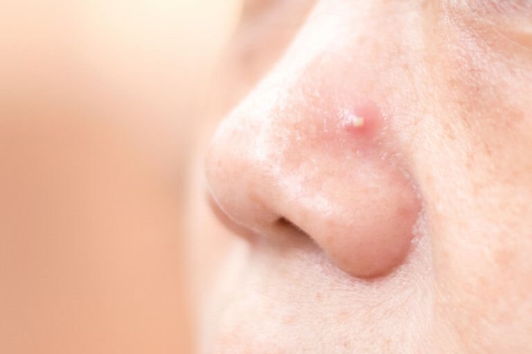 4 σπιτικές θεραπείες για να ξεφορτωθείτε τα σπυράκια στη μύτη!