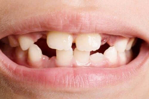 Οδοντική αγενεσία: Τύποι και τρόποι αντιμετώπισης