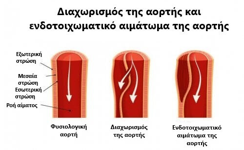 Φυσιολογική και μη αορτή