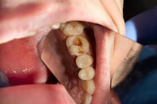 Τερηδόνα: Τι προκαλεί τις οδοντικές κοιλότητες;