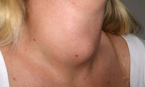 Γυναίκα με εξόγκωμα μπροστά στο λαιμό