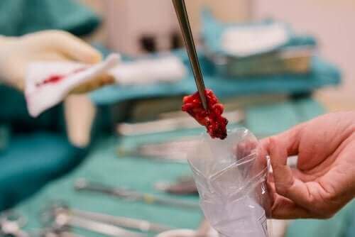 Παραδοσιακή βιοψία