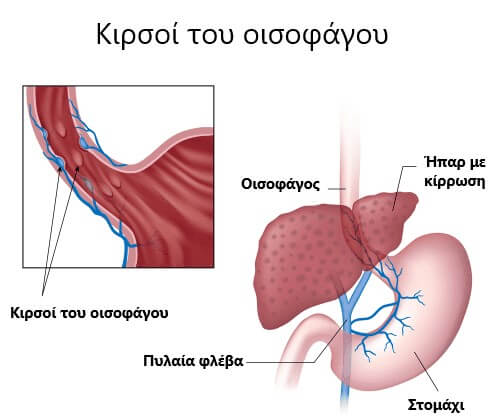 Κιρσοί του οισοφάγου: Σημάδια και συμπτώματα