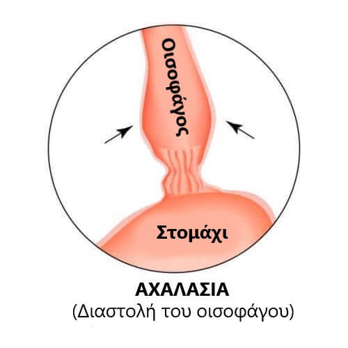 Διάγραμμα αχαλασίας του οισοφάγου