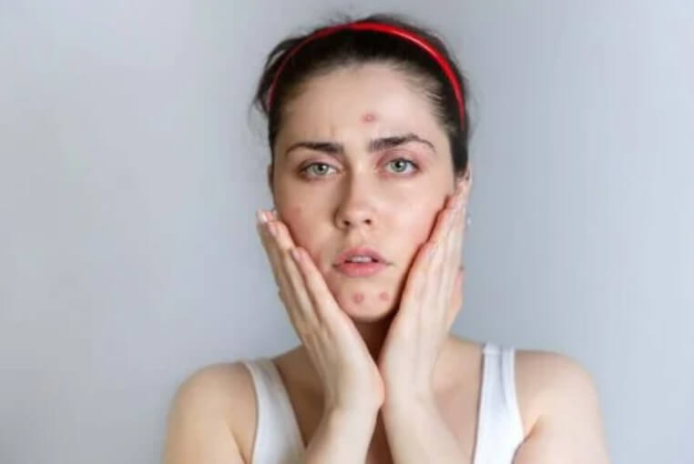 γυναίκα με ακμή