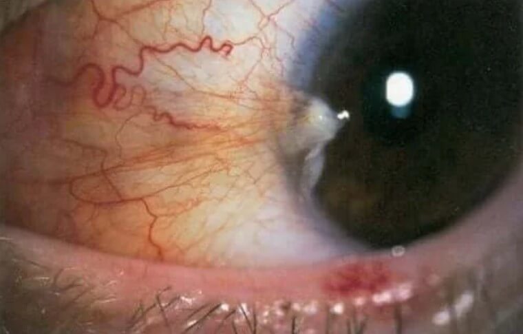 εξέταση ματιού