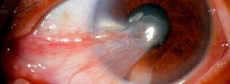 μάτι με πτερύγιο