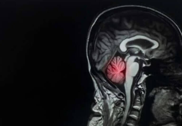 Μετάσταση εγκεφάλου: Περιγραφή και θεραπεία