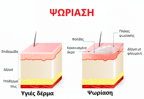 Απεικόνιση της ψωρίασης