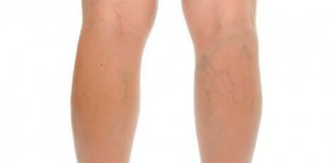 Άτομο με κιρσούς