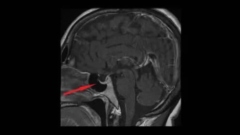εγκεφαλος και υποθάλαμος