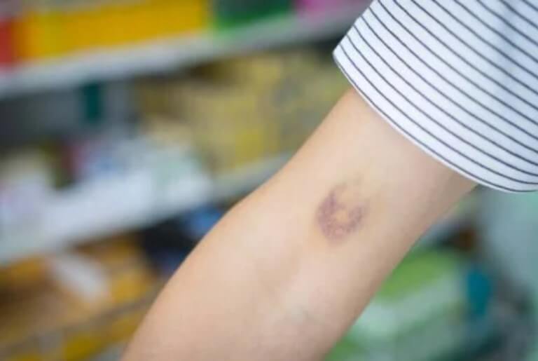 μώλωπας σε χέρι