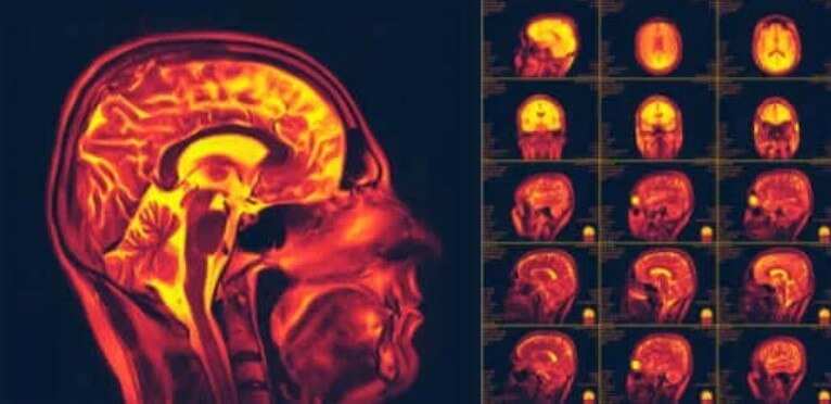 Τι είναι η νευροπλαστικότητα στον εγκέφαλο;