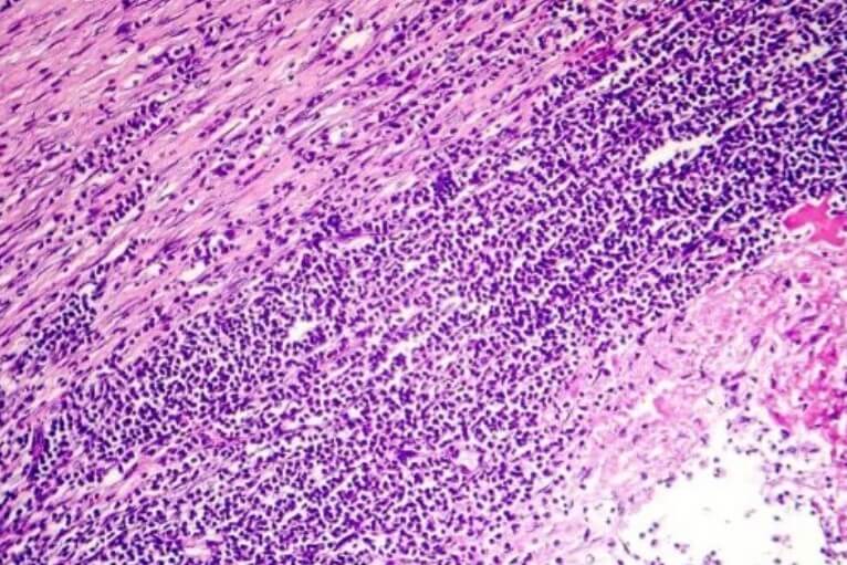 απεικονιση περικαρδιτιδας