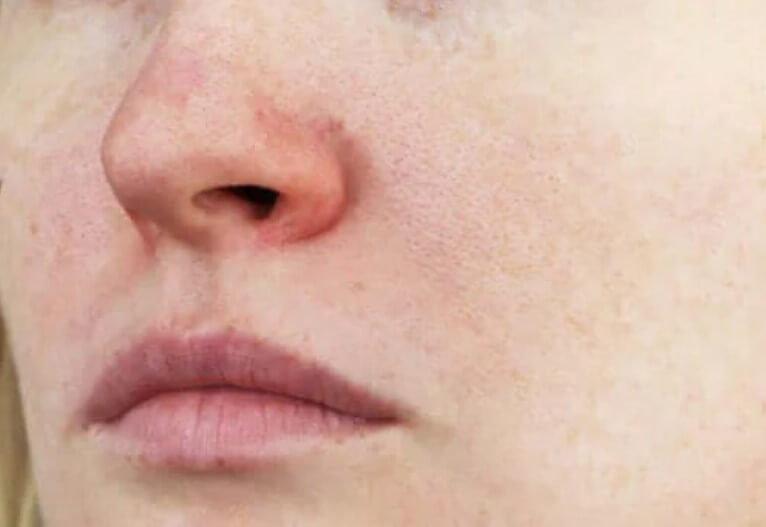Ευρυαγγείες στο πρόσωπο: Χαρακτηριστικά και θεραπεία
