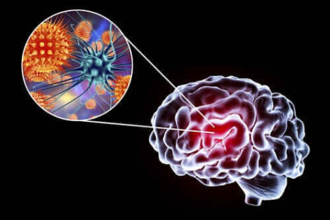 Εγκεφαλίτιδα: Συμπτώματα, αιτίες, και θεραπείες