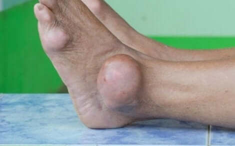 Πόδι πρησμένο εξαιτίας ουρικής αρθρίτιδας