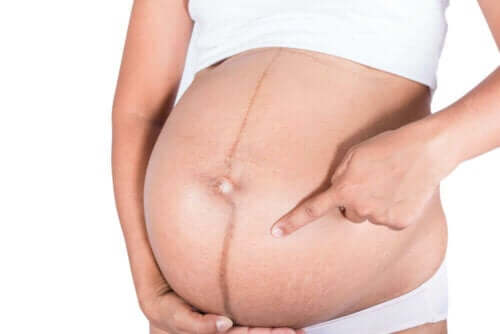 Έγκυος γυναίκα δείχνει τη μαύρη γραμμή στην κοιλιά της