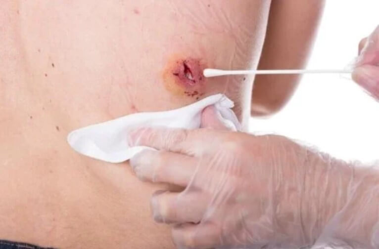 κύστη στην πλάτη