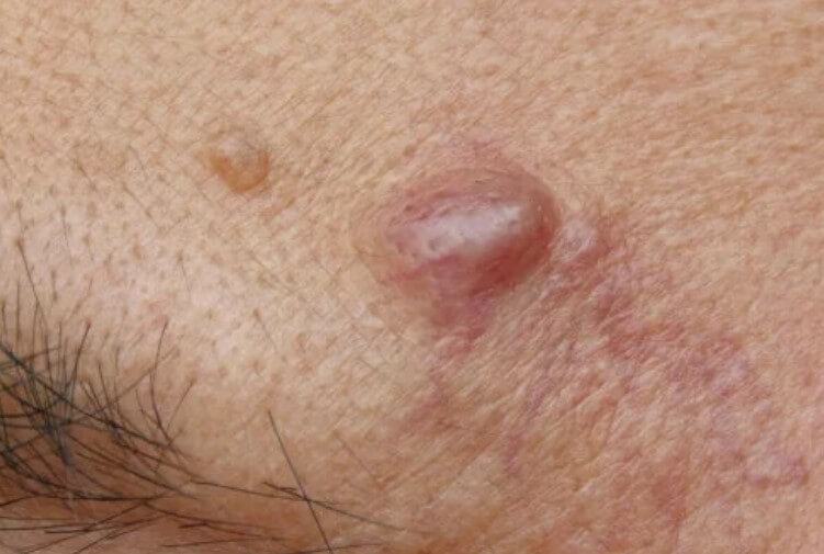 κύστη στο μέτωπο