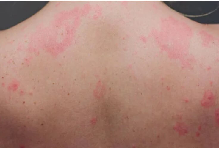 κνίδωση στην πλάτη