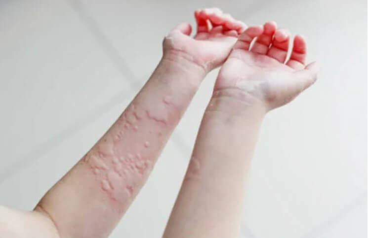 χέρια με κνίδωση