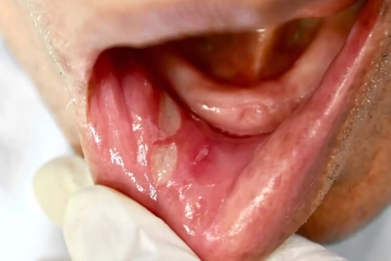 άφθες στο στόμα