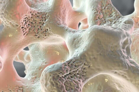Απεικόνιση οιδήματος του μυελού των οστών