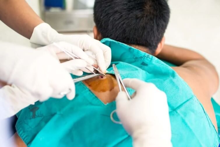 εγχείριση για ελιές