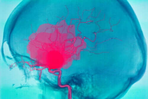 Τι είναι η ενδοεγκεφαλική αιμορραγία και γιατί μπορεί να συμβεί;