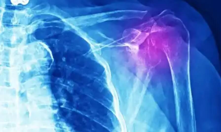 ακτινογραφία ώμου